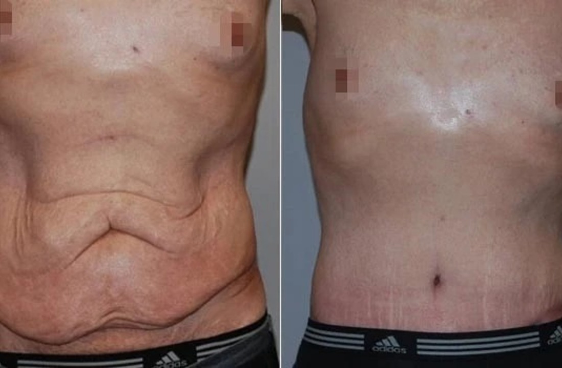 ابدومینوپلاستی