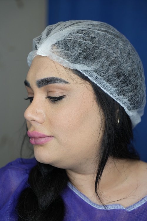 ساکشن غبغب