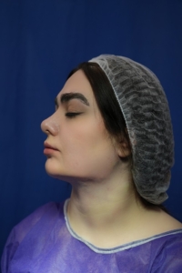 ساکشن غبغب