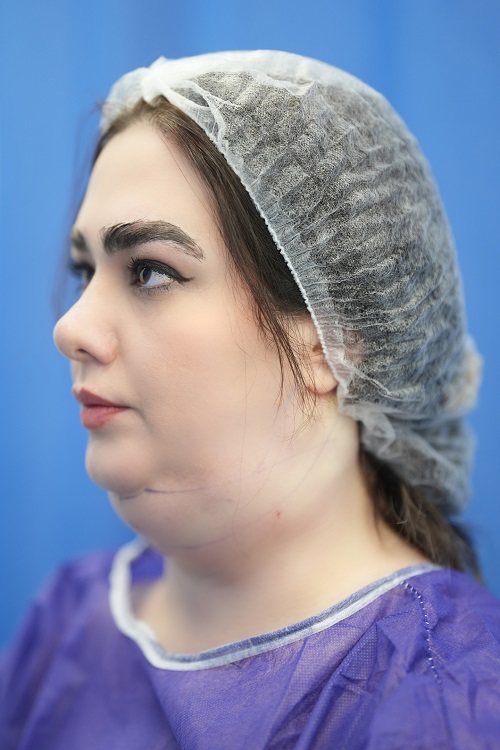 ساکشن غبغب